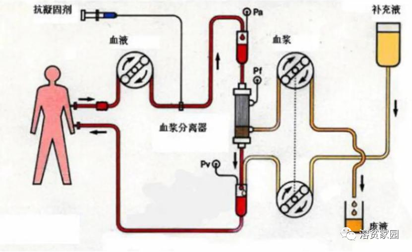 科普时间 | 淋巴细胞血浆置换和全血置换术——血浆置换的中杯、大杯、超大杯